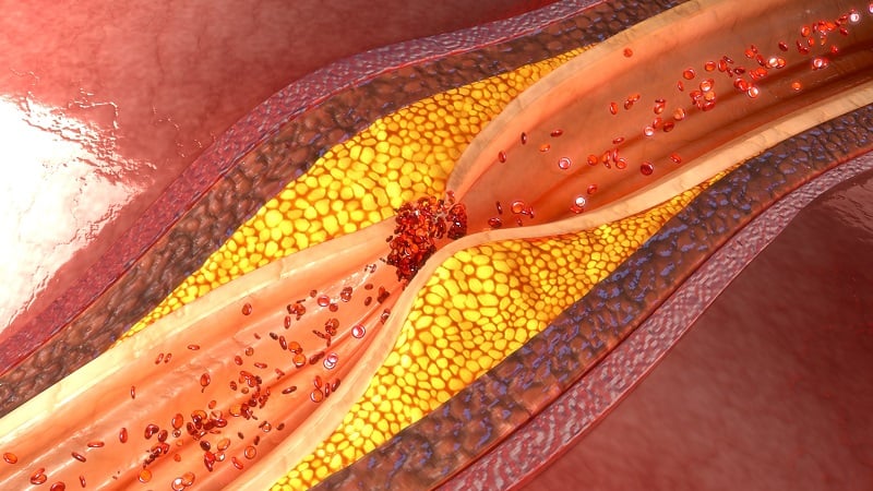A cartoon of an atherosclerotic blood vessel showing a blockage 