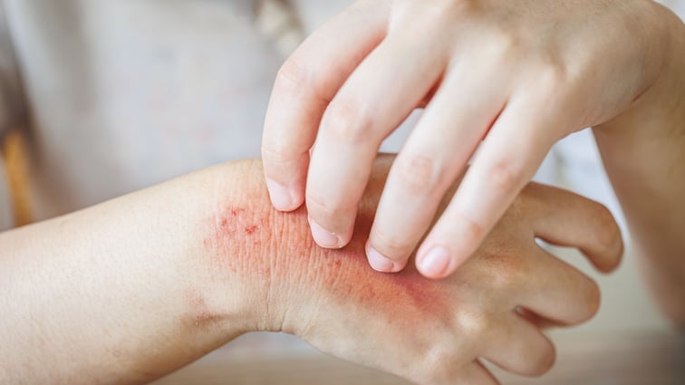 Using Ex Vivo Skin Explants to Study Local Immune Responses in Psoriasis and Atopic Dermatitis