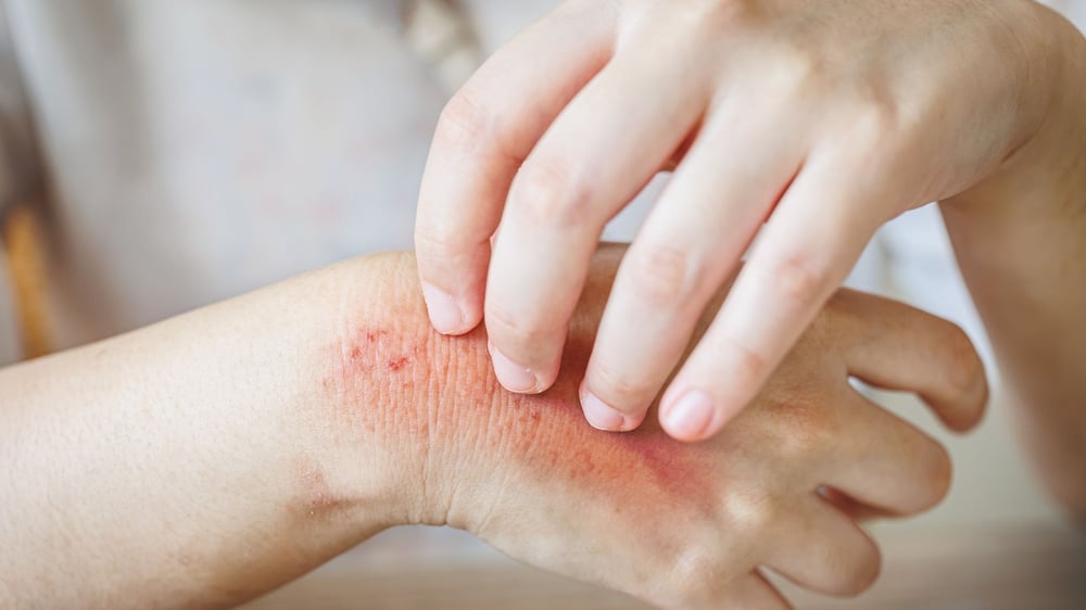 Using Ex Vivo Skin Explants to Study Local Immune Responses in Psoriasis and Atopic Dermatitis