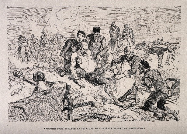 Ambroise Paré, on the battlefield using a ligature for the artery of an amputated leg of a soldier.  Wood engraving by Charles Maurand after E. Morin.