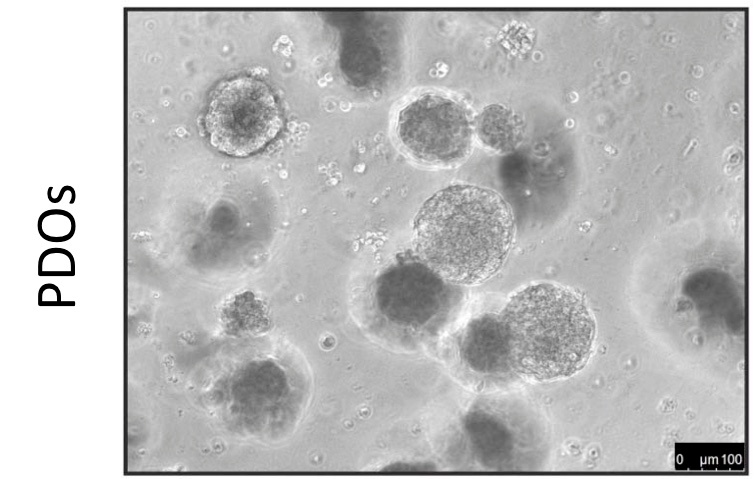 Patient-derived tumor organoids recapitulate clinical treatments
