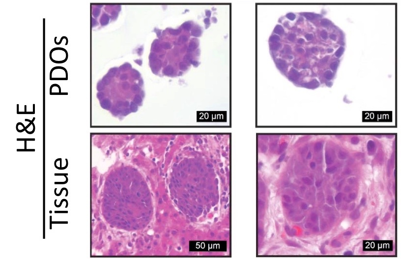 Patient-derived tumor organoids recapitulate clinical treatments