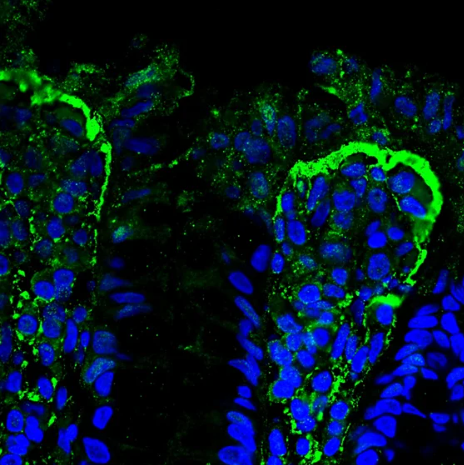 IBD epithelia stromal interface biomarker MMP-9