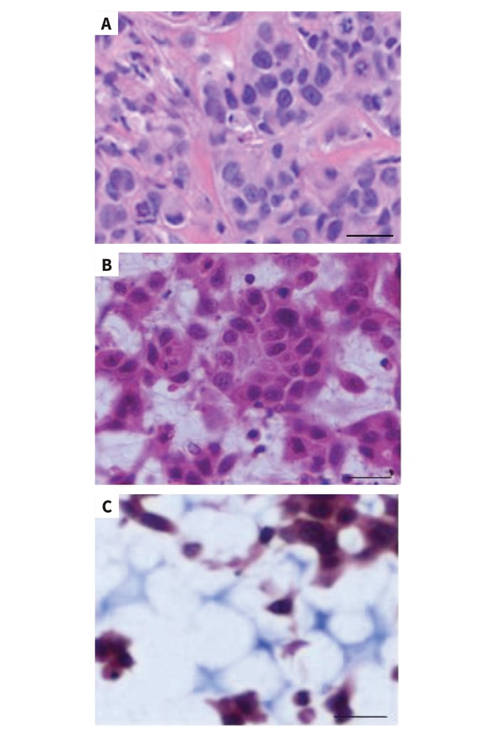 Long-term culture of MCF-7 cells on Alvetex Scaffold results in xenograft-like structures.