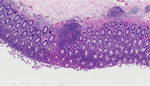 Microscope image of a diseased colon with Crohns disease