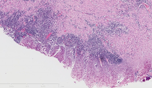 Microscope image of a diseased colon with Ulcerative colitis 