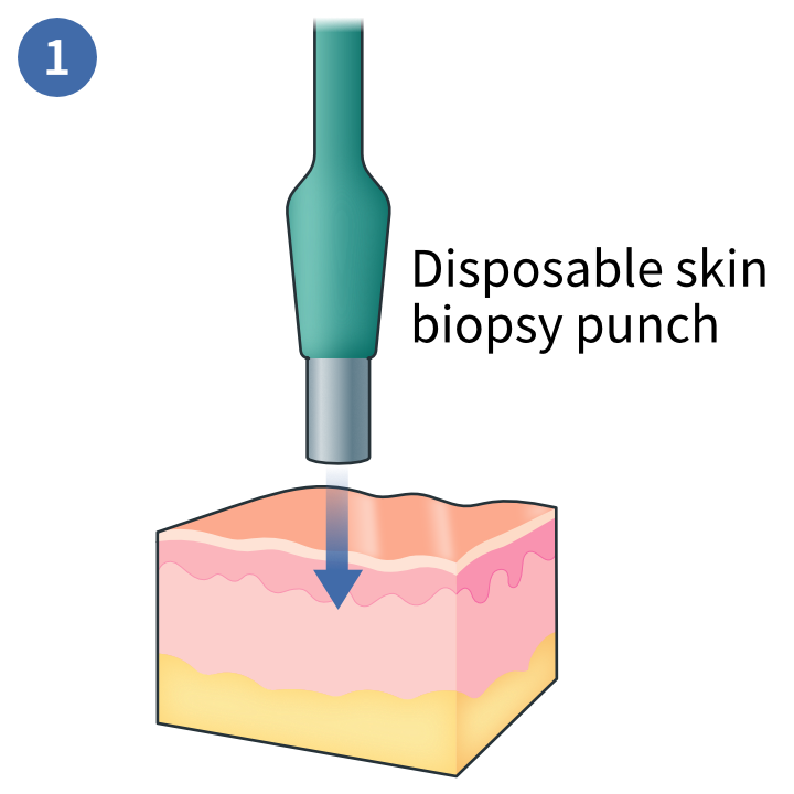 Skin punch biopsy